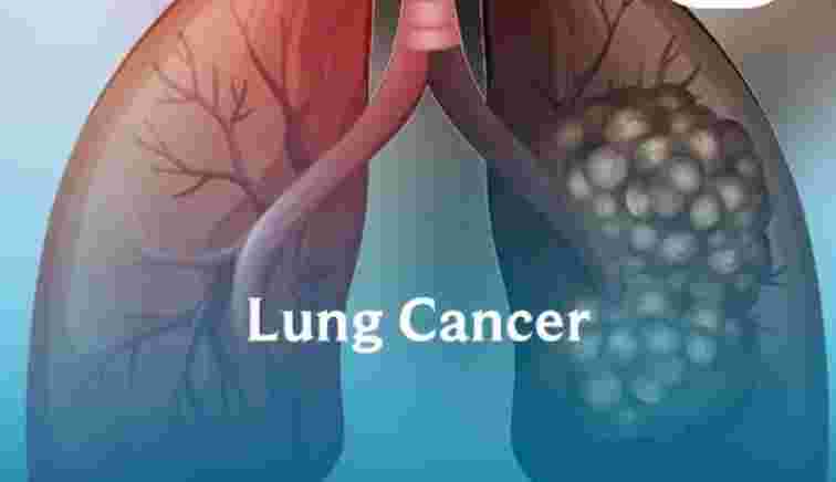 AI Technology Could Dramatically Lower Lung Cancer Mortality Rates: Chris Wood